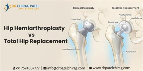 hip hemiarthroplasty orthobullets|The optimal approach in hip hemiarthroplasty: a cohort.